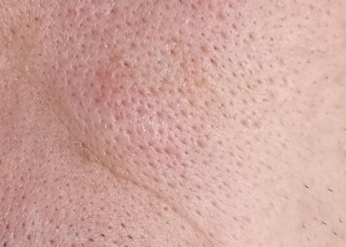 Ultrahidratante_antes_2